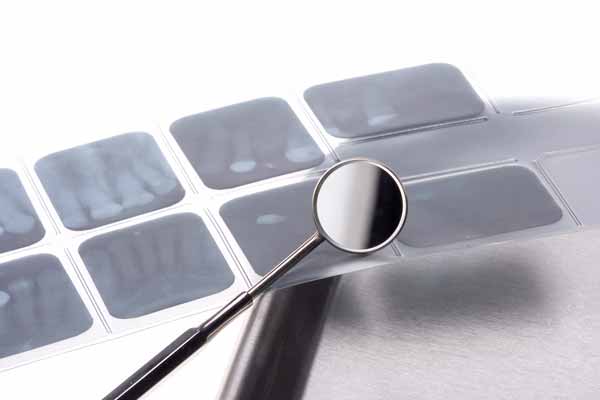 Digital X-rays North Vancouver Dentist