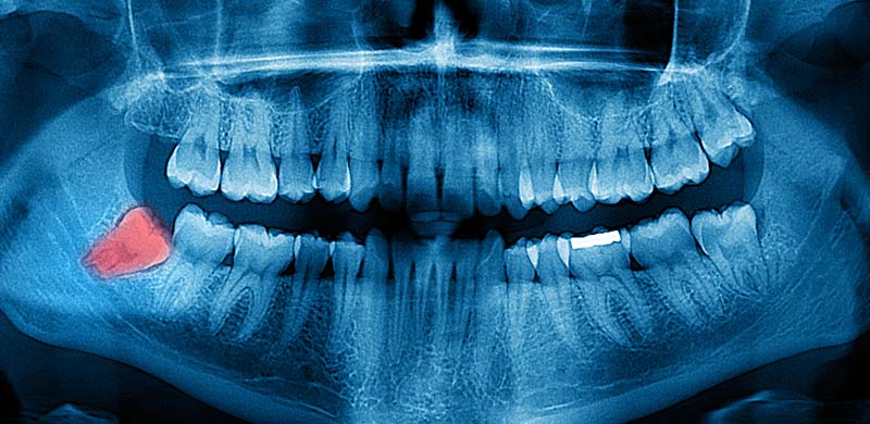 Wisdom Teeth Removal North Vancouver