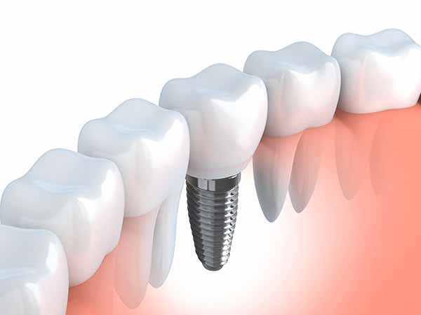Dental Implants North Vancouver