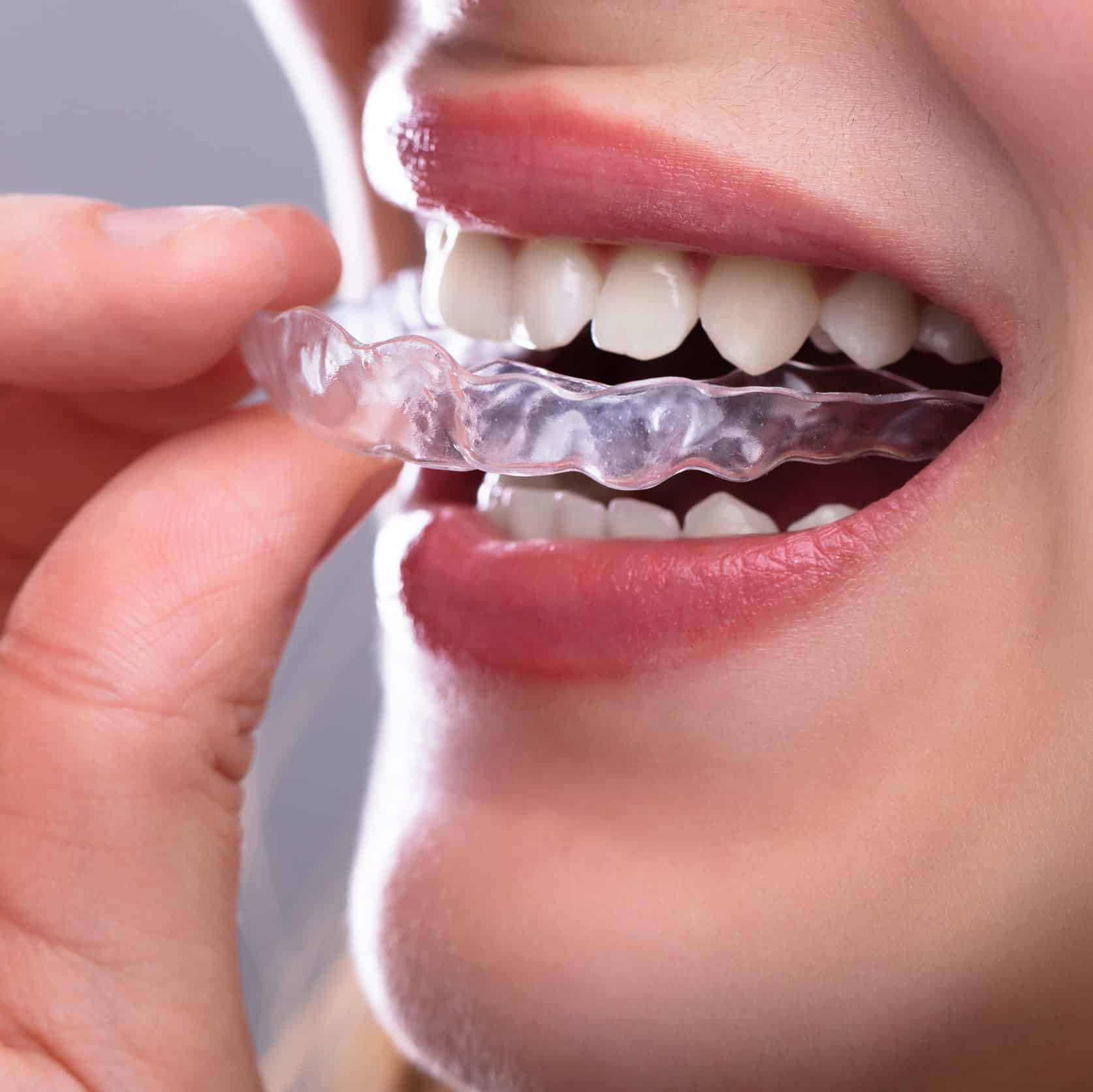 invisalign for straighter teeth