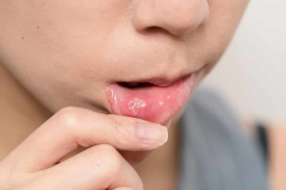 Can Toothache Cause Canker Sores