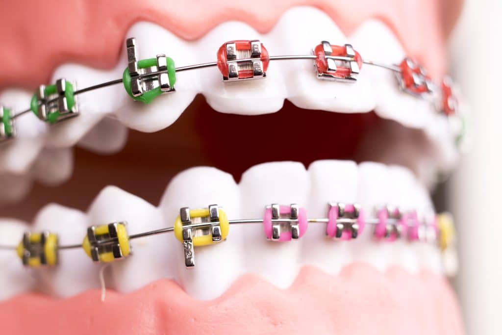 North Vancouver Orthodontics Traditional Braces