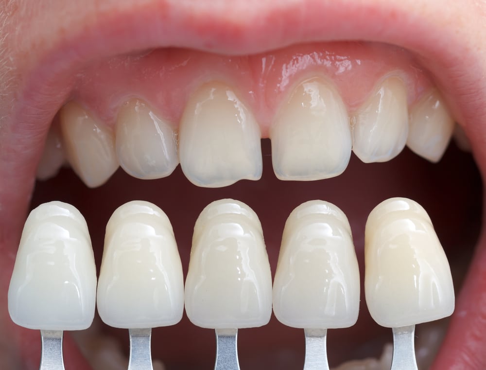 teeth in need of dental veneers