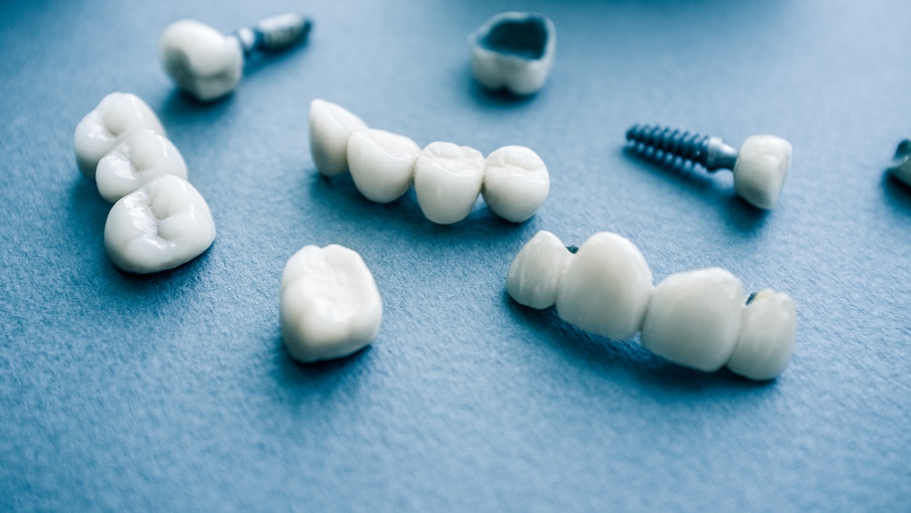 what is dental implants