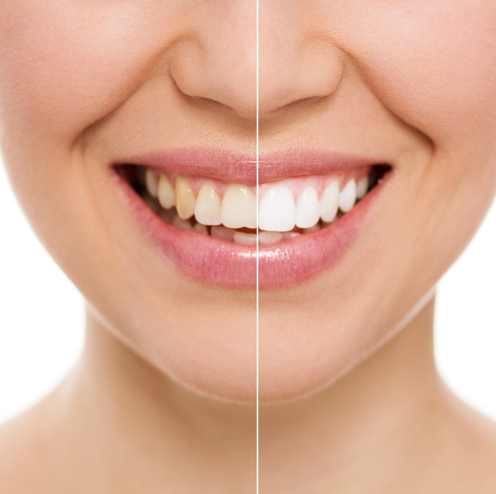 laser teeth whitening result