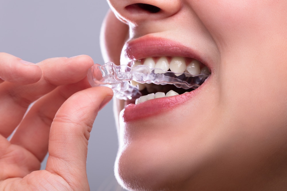 Woman Putting Transparent ClearCorrect Aligner In Teeth