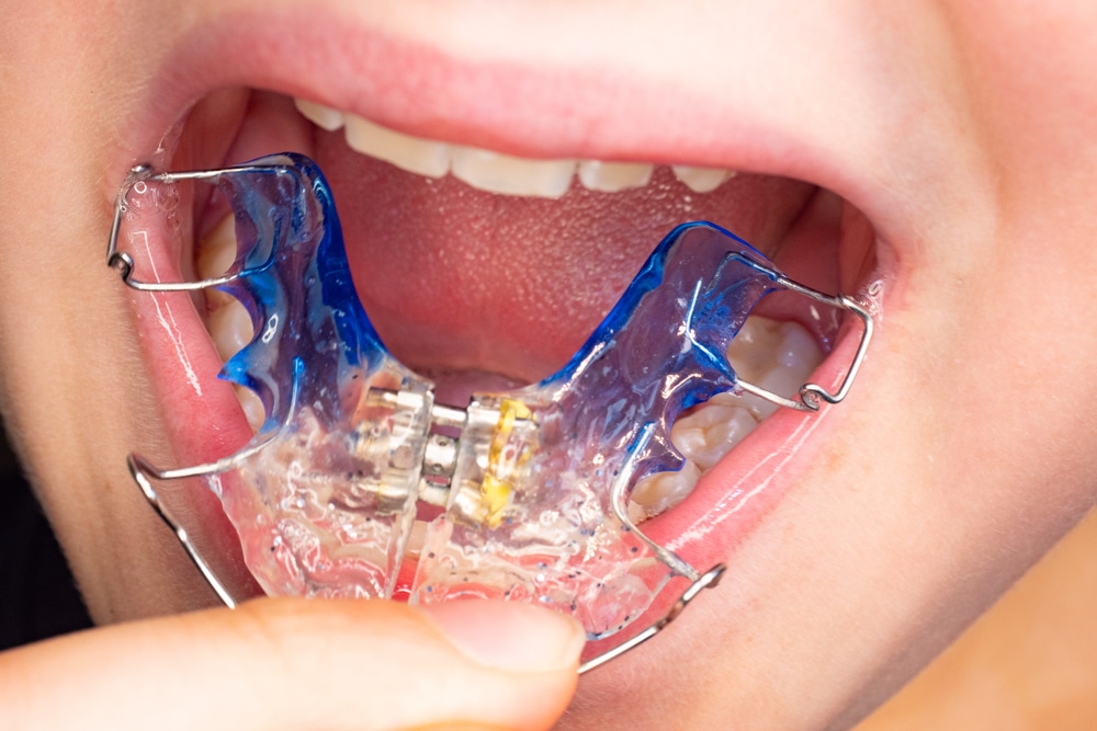 Patient photo of teeth with orthodontic braces