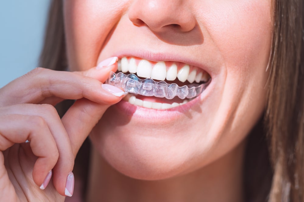Invisalign Vancouver, Teeth Straightening, Clear Aligners