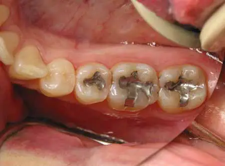 Restorative Dentistry fillings replacement