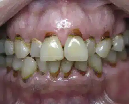 Restorative Dentistry full rehabilitation