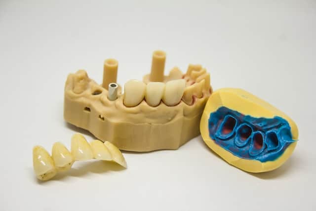 Emergency Dentist In Vancouver broken tooth