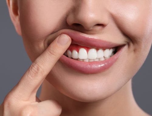 Gum Recession: Symptoms, Causes, and Treatment