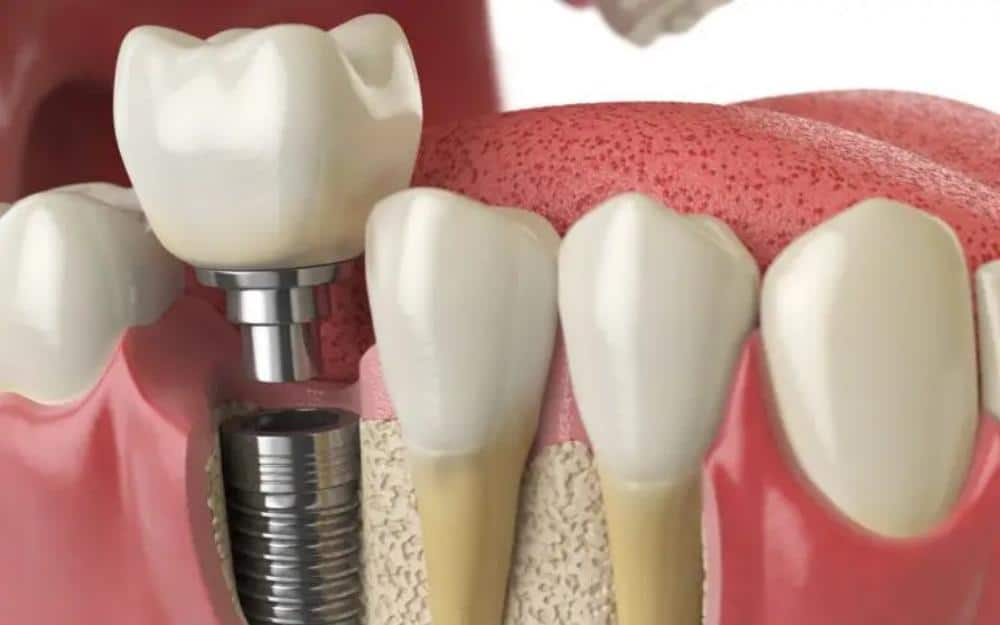 tooth-implant-costs-in-North-Vancouver