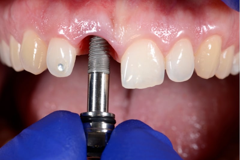what are Dental Bridges