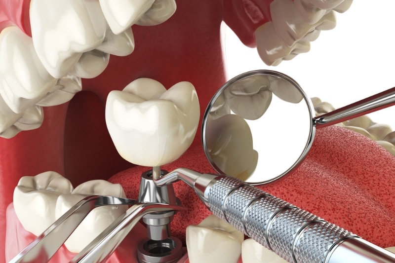 different types of Dental Bridges