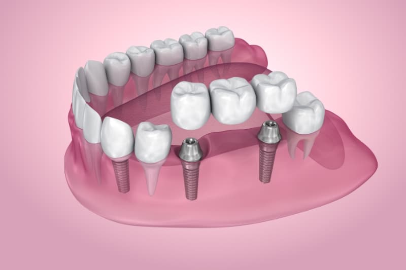 implant-supported Dental Bridges